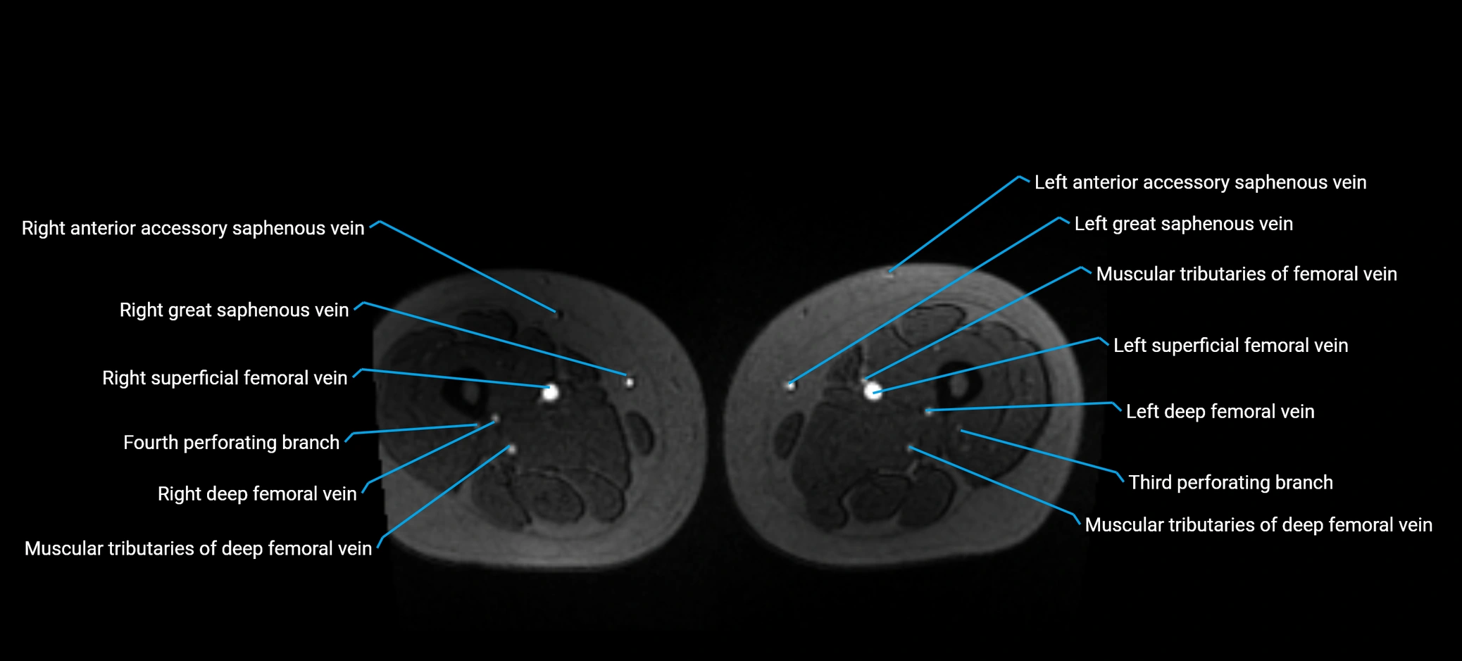 MRV abdomen pelvis & lower limb axial cross sectional anatomy labelled MRI image 269 (1).webp
